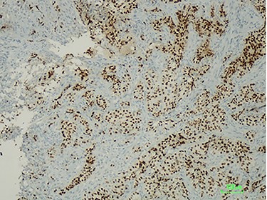 Immunostaining positive for PAX8 suggesting a tumour of gynaecologic origin based on the patient’s past medical history.