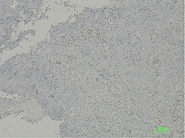 CDX2 negative immunostaining excluding carcinoma of intestinal origin such as primary duodenal neoplastic lesion.