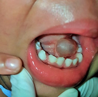 Two-year-old boy with cystic lesion at floor of month combined with ankyloglossia.
