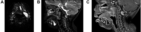 (A) On axial view, MRI demonstrated multi-lobulated cystic mass, which showed hypersignal intensity on T2 weighted image involving left sublingual, submandibular, pharyngeal and parapharyngeal spaces; (B) On sagittal view, MRI demonstrated multi-lobulated cystic mass, which showed hypersignal intensity on T2 weighted image involving left sublingual and submandibular spaces; (C) On sagittal view, MRI demonstrated multi-lobulated cystic mass, which showed hyposignal intensity on T1 fat suppression with gadolinium involving left sublingual and submandibular spaces.