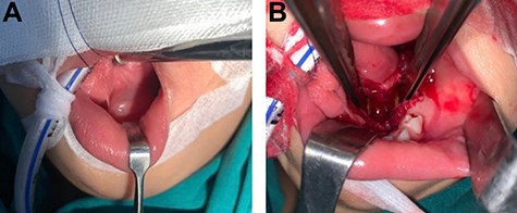 (A) The operation was performed under general anesthesia; (B) Frenotomy was performed then cystic mass was removed and it showed leave cavity on sublingual and submandibular spaces.