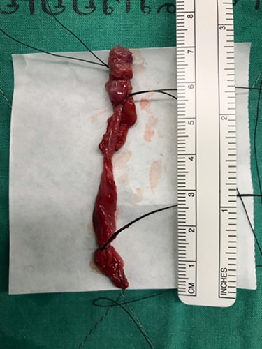 The specimen showed a multi-lobulated cystic cavity with leakage of fluid content.
