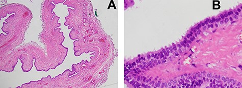 (A) Microscopic examination was demonstrated a unicystic lesion lined by ciliated pseudostratified columnar and cuboidal cells (low-power field); (B) Microscopic examination was demonstrated ciliated pseudostratified columnar and cuboidal cells lining. Goblet cells were not discerned. Subepithelial stroma revealed only fibrovascular tissue (high-power field).