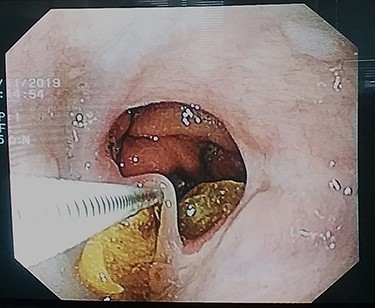 Endoscopic appearance of the bulky food particle impacted around the epithelial band arisen from the esophagogastric anastomosis.