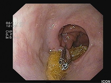 Placement of two hemoclips on both sides of the anastomotic band prior to transection, in a scope’s straight position.