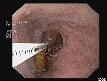 Flexible endoscopic scissors transecting the epithelial band in between the hemostatic clips.