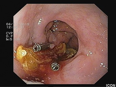 The large food material is released from the esophageal lumen with no blood loss.