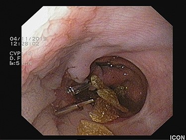 The foreign body is fragmented with grasping forceps to facilitate transoral removal.