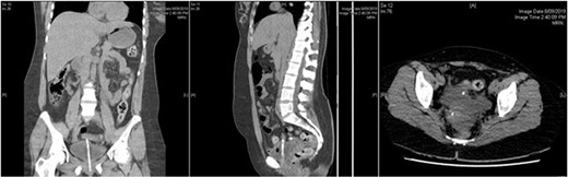 Abdominal CT showing urinary catheter protruding through dome of bladder.