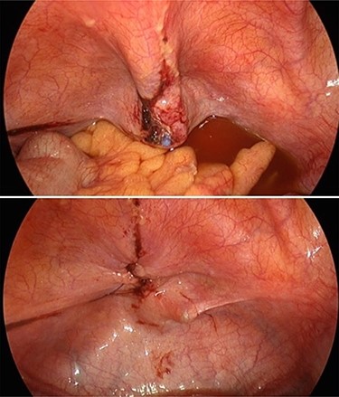 Intraoperative photo showing tip of Foley catheter protruding through bladder wall and subsequent repair.