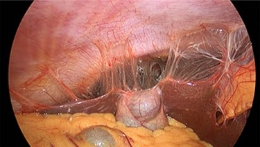 Intraoperative photo showing violin-like adhesions on liver.