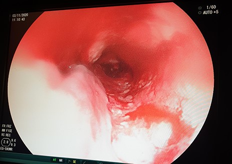 OGD showing a fungating tumour at 20 cm from the upper incisors with almost complete luminal obstruction.