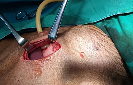 24Fr catheter gastrostomy in Stamm technique.