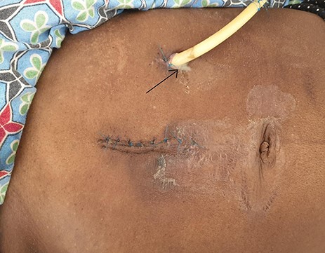 Peristomal surgical site infection (arrow).