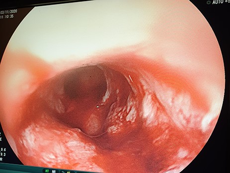 OGD showing a fungating mass partially obstructing esophageal lumen.