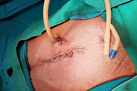 24Fr catheter as gastrostomy tube.