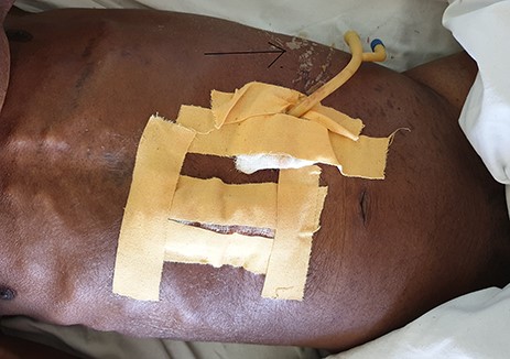 Peristomal leakage (arrow).