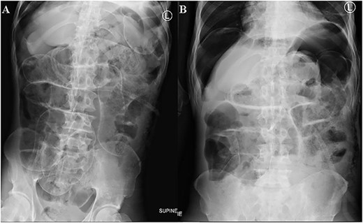Supine (A) and erect (B) abdomen X-rays show dilated small bowel loops with multiple air fluid levels. Free air seen underneath the hemidiaphragm bilaterally and outlining both sides of the small bowel walls (Rigler sign) suggestive of pneumoperitoneum.