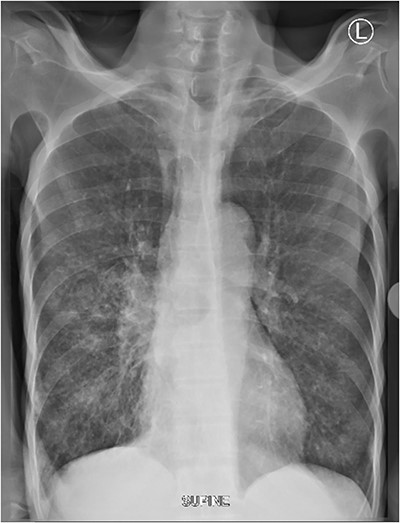 Supine chest X-ray shows patchy infiltrates in the right mid and lower zone with micronodular infiltrates. Micronodules seen in the left lower zones.