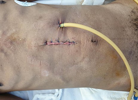 24Fr urinary catheter as an improvised gastrostomy feeding tube.