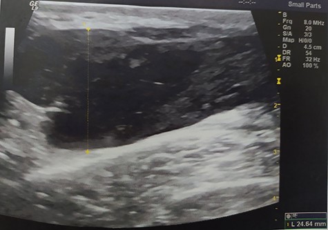 Pelvic ultrasound indicating an acute hematoma into the fatty tissue of the right iliac fossa.
