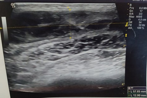Pelvic ultrasound indicating an acute/nonorganized hematoma into the fatty tissue of the right iliac fossa, with thrombotic features.
