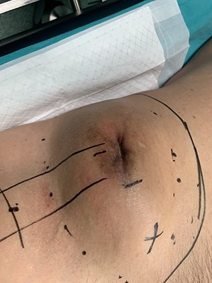 Patient’s appearance on physical examination. Swelling of the right ilioinguinal area and palpation of a large, hard mass into the right iliac fossa.