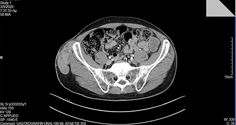 A large lipomatous mass detected in the MRI.