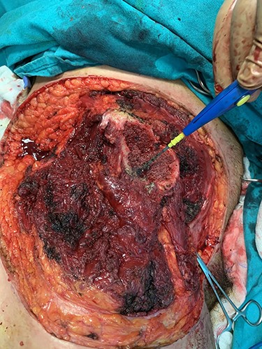 Liposarcoma complete resection.