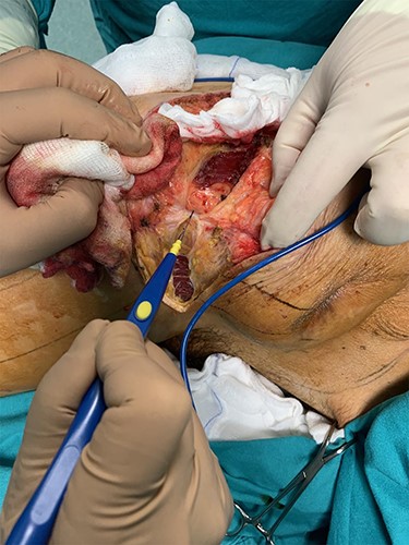 Elective resection of the right iliac crest and part of the right gluteus maximus muscle.