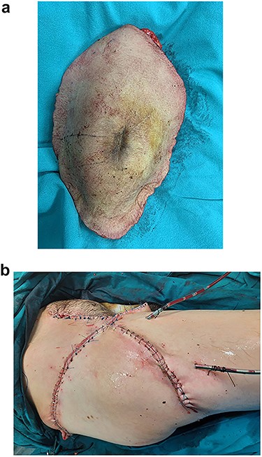 The resected liposarcoma with the adjacent tissues, for the elimination of the potentiality of local recurrence.
