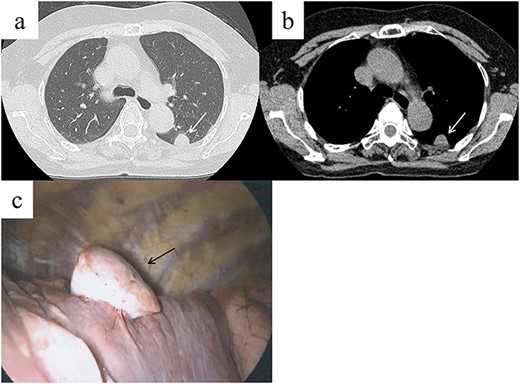 Chest computed tomography (CT) shows a well-demarcated solid nodule in the left lower lobe adjacent to the pleura (a, b, white arrow). Intraoperative findings show a stemmed tumor arising from the visceral pleura of the left lower lobe (c, black arrow).