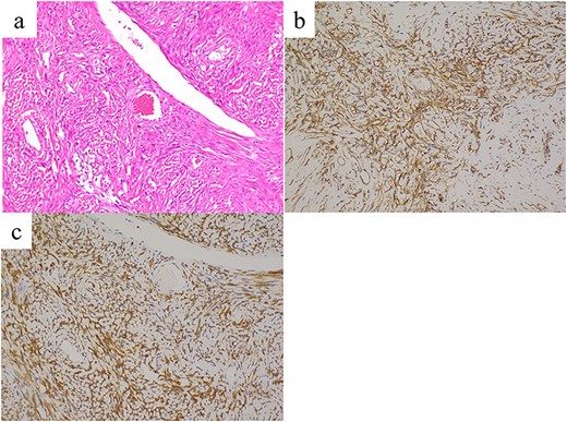 Histopathological findings reveal proliferating spindle cells with intermittent collagen fibers (a, hematoxylin and eosin staining). These tumor cells are immunohistochemically positive for (b) CD34 and (c) bcl-2. Images were taken at ×20 magnification.