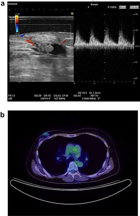 Ultrasound of the right breast in case 1 revealed a mass-like lesion 16.6 × 10.0 × 4.9 mm (a), and PET-CT showed that the right breast mass had an SUV max of 2.7 (b).