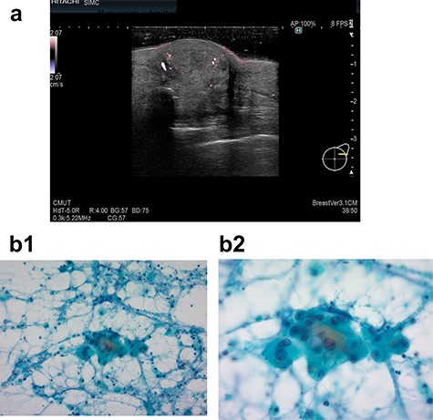Ultrasound examination in case 2 revealed a mass 19.4 × 18.8 × 10.7 mm in the left breast (a) and cytodiagnosis did not unclear that it showed local recurrence. (b-1: ×20 magnification, b-2: ×40 magnification).