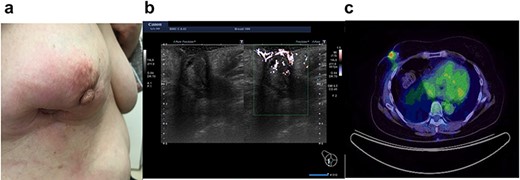 Case 3 presented with erythematous changes in the skin of the right breast (a). Ultrasound evaluation revealed a mixed pattern mass lesion 26.3 × 34.8 × 25.0 mm in the right breast (b), and PET-CT showed a right breast mass with an SUV max of 4.0 (c).