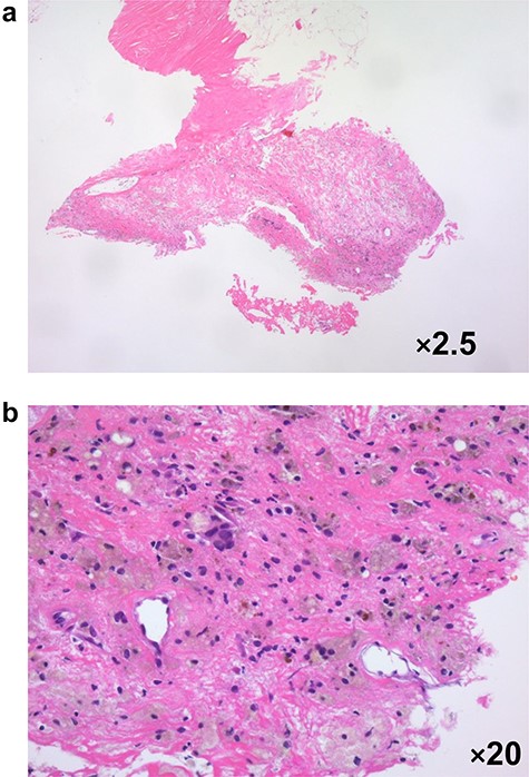 Pathological evaluation of a vacuum-assisted core needle biopsy specimen in case 3 revealed xanthogranulomatous inflammation with micro-calcification a: ×2.5 magnification, b: ×20 magnification.
