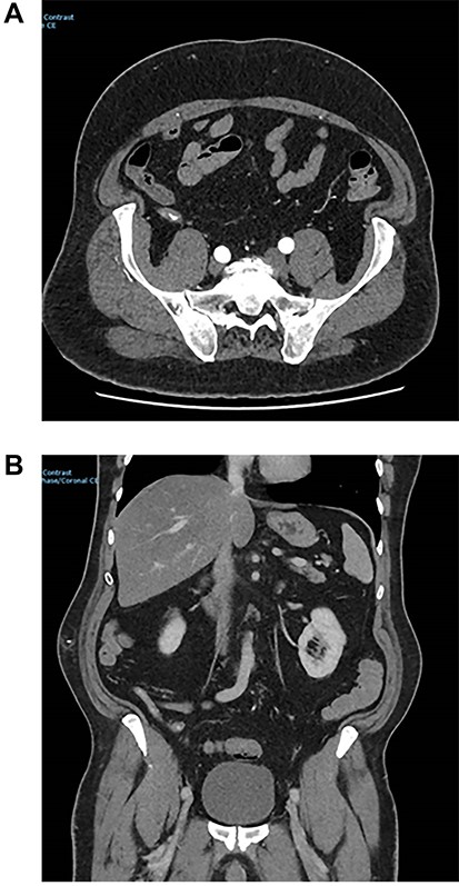 CT images of arterial appendix blush.