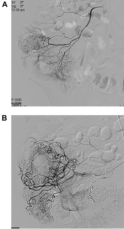 Images from angiography. (A) Pre-embolization, demonstrates appendiceal lumen filled with contrast. (B) Demonstrated coiled artery.