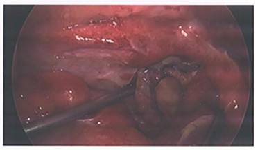 Image from laparoscopic appendicectomy.