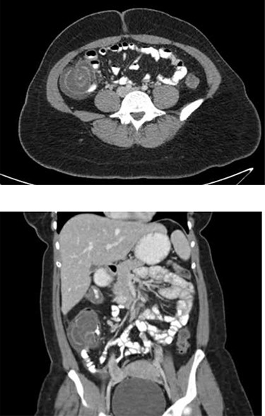 Representative axial (top) and coronal (bottom) images from patient’ s CT abdomen/pelvis with PO and IV contrast demonstrating cecal thickening and ileocolic intussusception.