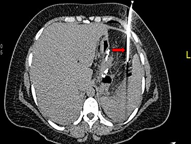 CT guided drain of intra-abdominal collection.
