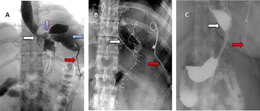 (A) Oral contrast medium showing communication between the lower esophagus and the site of collection drained by percutaneous pigtail catheter. (B) Distal esophageal stent was placed to cover the site of fistula. (C) No contrast extravasation.