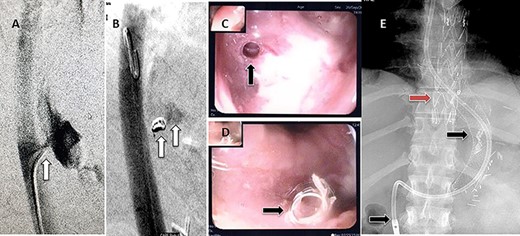(A) Aortography showed active contrast extravasation to the esophagus trough the fistula. (B) Coli embolization of the AEF with contrast beyond the coil. (C) Esophagogastroduodenoscopy revealed the site of the fistula and the coil embolization in the stomach. (D) An esophageal stent was placed extending to the stomach and the aortic stent in place. Feeding tube in place.