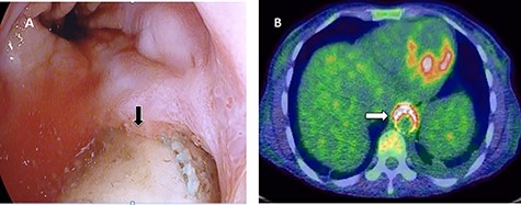 Esophagogastroduodenoscopy revealed thoracic endovascular aortic stent can be seen in the distal esophagus. (B) PET scan showing increase FDG activity around the distal aortic stent.