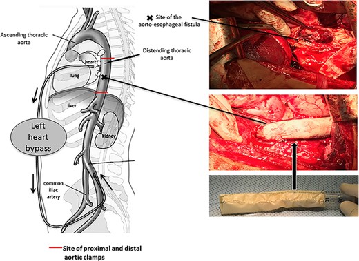 Pericardial bovine patch converted to a graft replacing the descent thoracic aorta at the site of fistula.