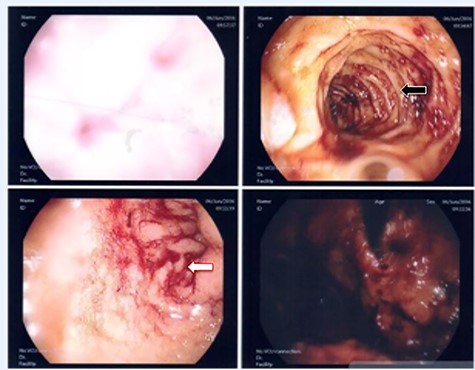 First upper endoscopy blood within the stomach and duodenum; the esophagus image was not clear and no active bleed can be seen.