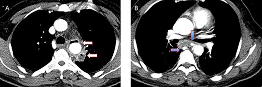 (A) CT study with contrast showing gas adjacent to the descending thoracic aorta with thickened soft tissue around the esophagus. (B) Vascular contrast within the esophagus and projecting outside the aorta forming ‘pseudoaneurysm’ or penetrating aortic ulcer.