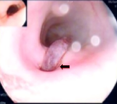 Second upper endoscopy fresh bleeding from the distal esophagus and after washing the blood an adherent clot extending from an ulcer going down into the stomach can be seen.