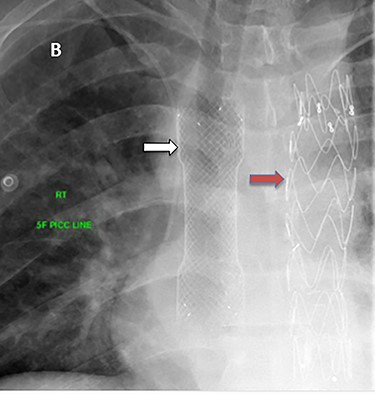 Esophageal stent (white arrow) and aortic stent (red arrow).